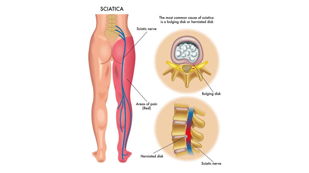 Are These Sciatica Symptoms Causing Your Pain