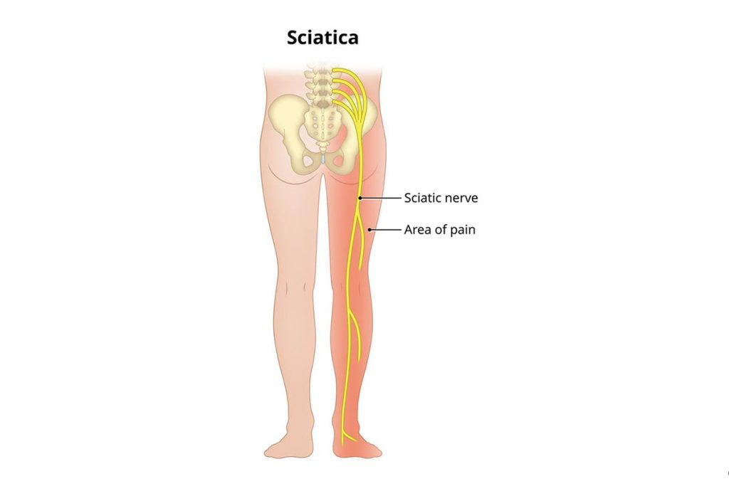 Is Dry Needling an Effective Treatment for Sciatica 3 1