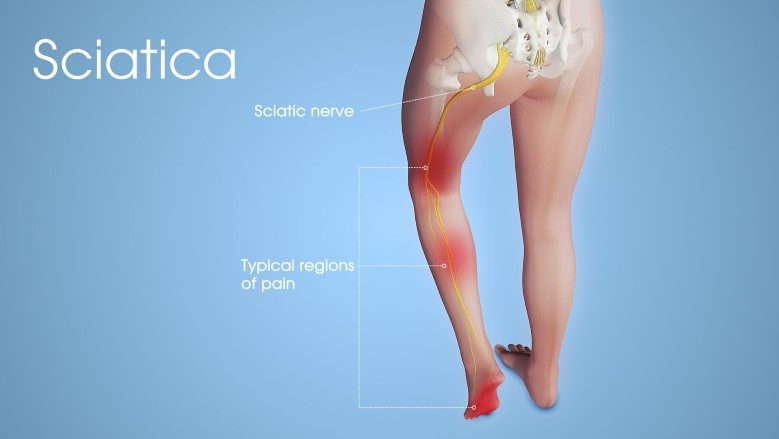 Sciatic Nerve Injury Sciatica