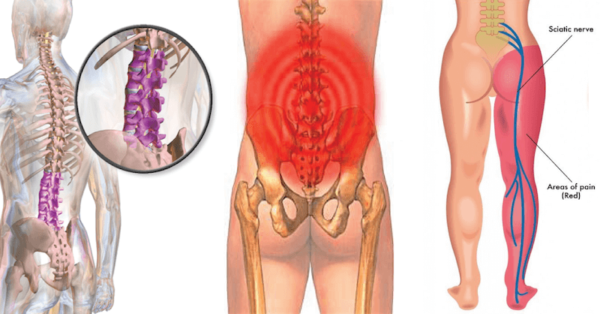 Sciatica Pain 600x314 1