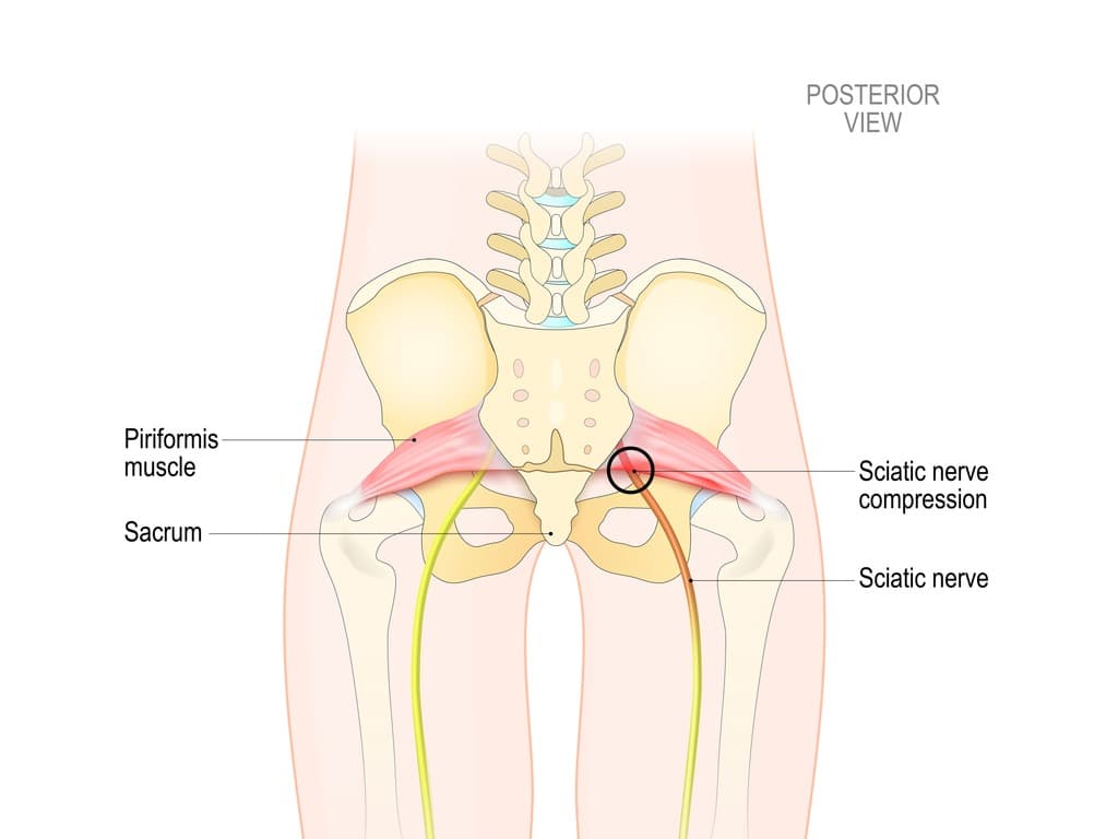 Sciatica hub nerve illustration