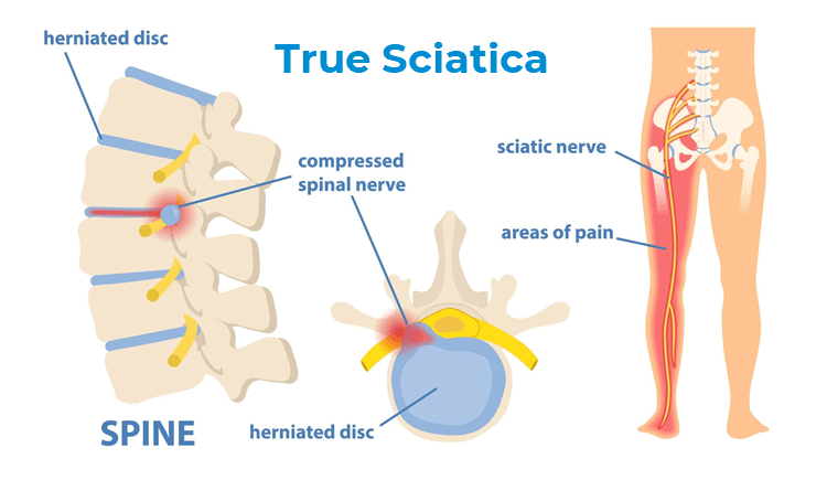 True sciatica1
