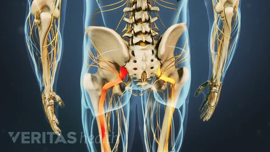 radiating pain sciatic nerve
