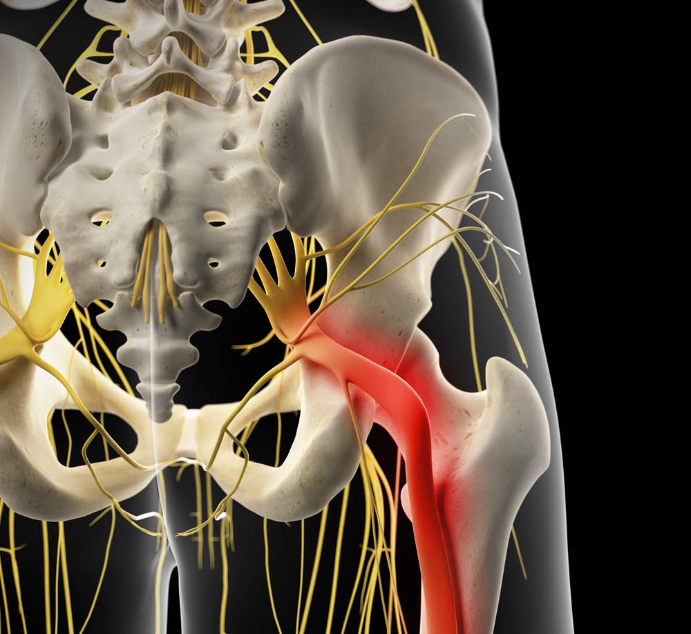 sciatic nerve pain 1