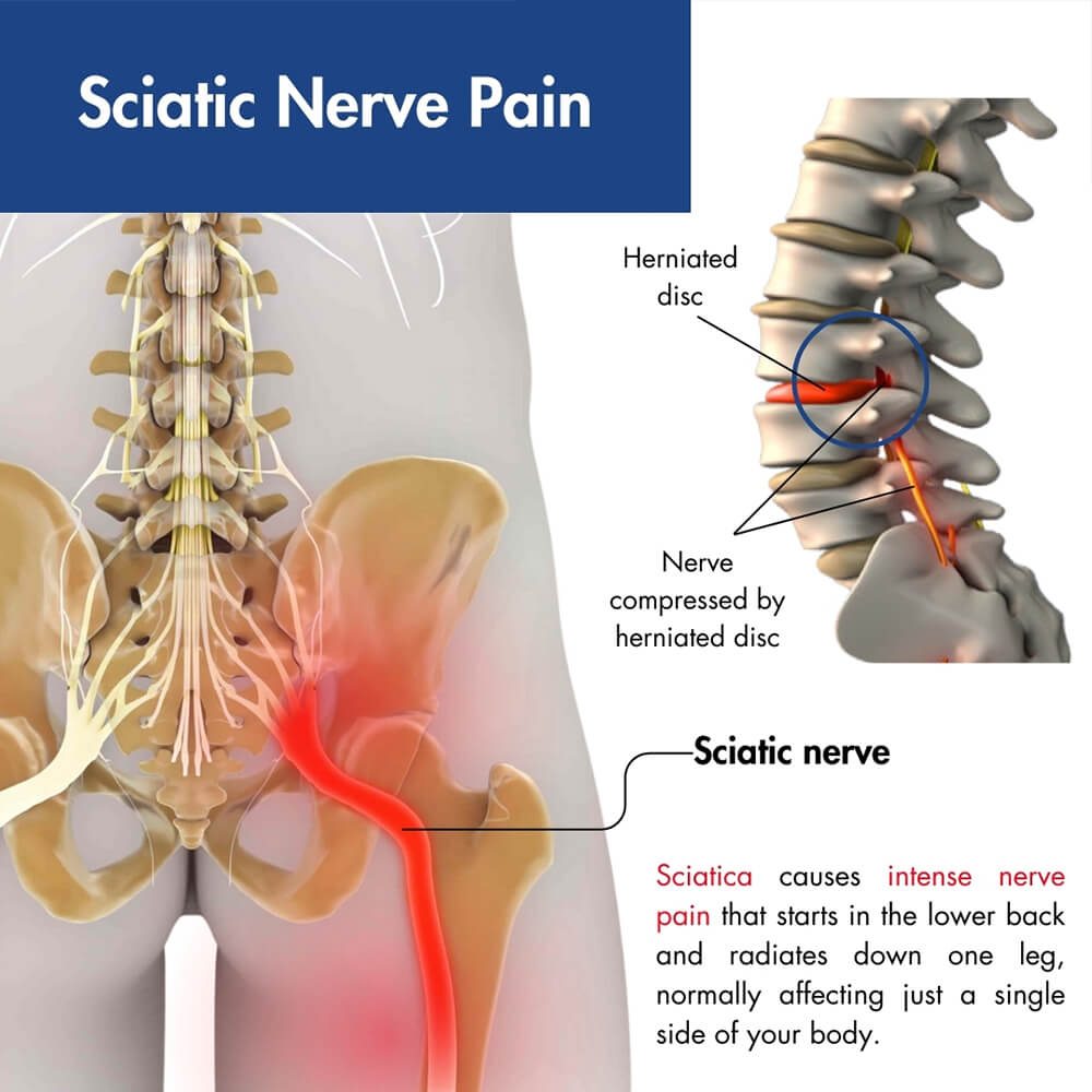 sciatic nerve pain2