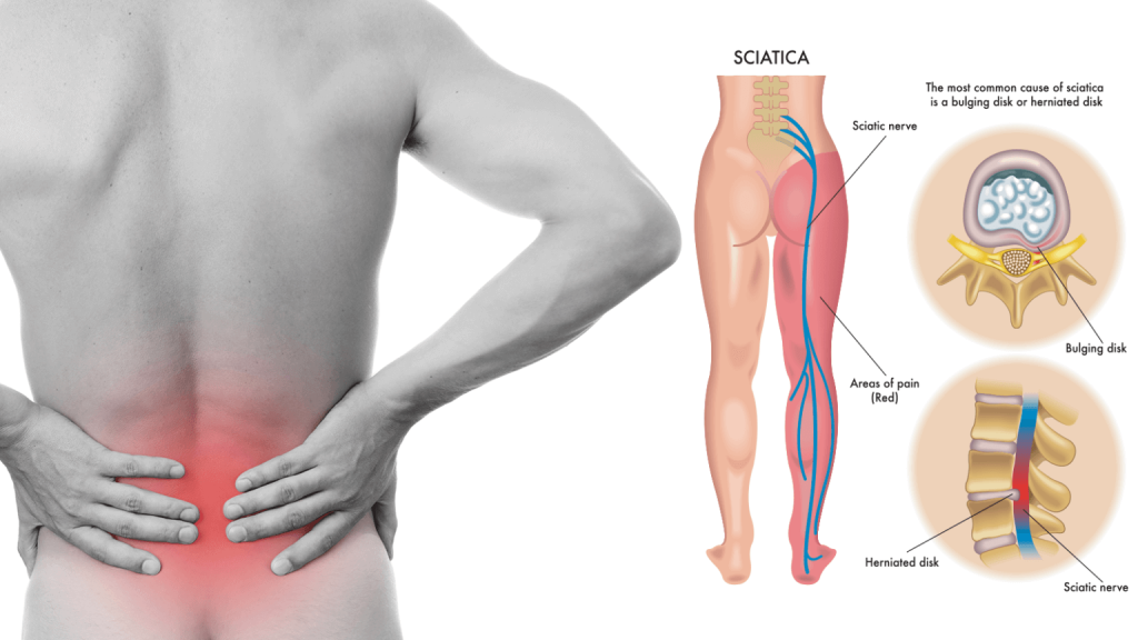 sciatic pain 1