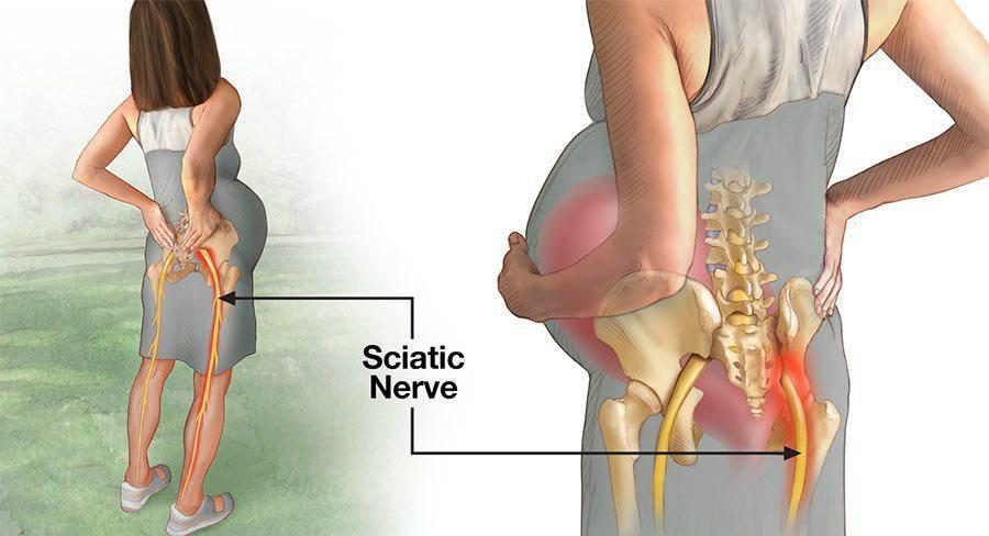 sciatica 5