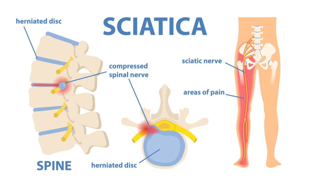 sciatica doctor in st louis missouri