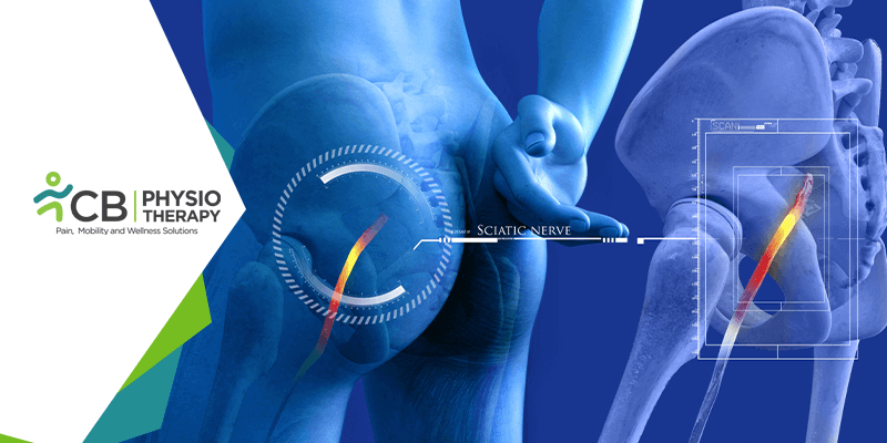 sciatica how physiotherapy management helps in relieving the sciatic nerve pain