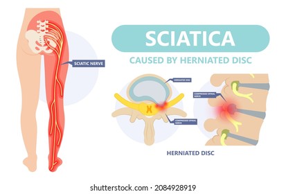 sciatica nerve pain lower back 260nw 2084928919
