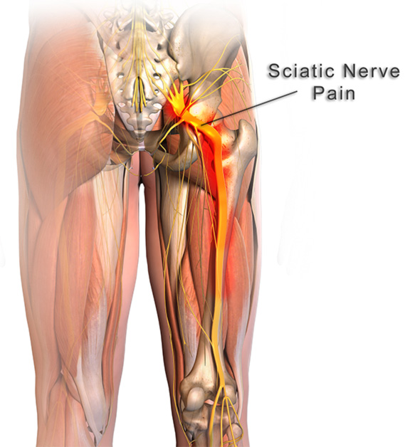 sciatica nerve pain orig