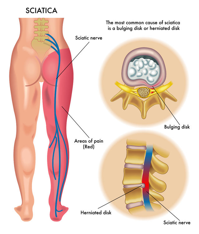 sciatica23117022 m